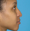 Foundation Septorhinoplasty