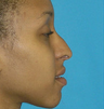 Foundation Septorhinoplasty