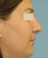 Closed Rhinoplasty Result