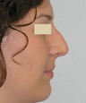 Closed Rhinoplasty Result