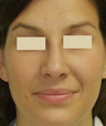 Closed Rhinoplasty Result