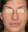 Closed Rhinoplasty Result