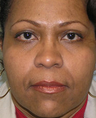 Botox and Filler Results