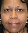 Botox and Filler Results