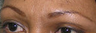 Botox and Filler Results