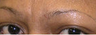 Botox and Filler Results