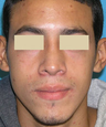 Functional and Cosmetic Septorhinoplasty Result