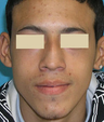 Functional and Cosmetic Septorhinoplasty Result
