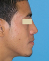 Functional and Cosmetic Septorhinoplasty Result