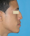 Functional and Cosmetic Septorhinoplasty Result
