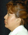 Liposuction of Chin