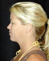 Liposuction of the Chin