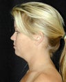 Liposuction of the Chin