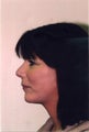 Neck Lift