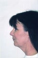 Neck Lift