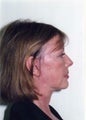 Neck Lift