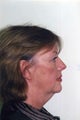 Neck Lift