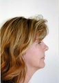 Neck Lift