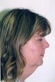 Neck Lift