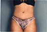 Mini Tummy Tuck