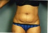 Mini Tummy Tuck