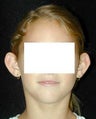 Otoplasty - Ear Surgery
