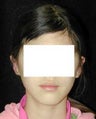 Otoplasty - Ear Surgery