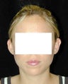 Otoplasty - Ear Surgery