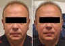 Correction of nasolabial folds and marionette lines with hyaluronic acid filler (eg. Juvederm / Restylane / Perlane)