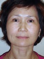 Mixto Laser and Upper Eyelid Surgery