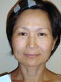 Mixto Laser and Upper Eyelid Surgery