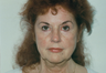 Brow Lift
