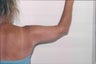 Arm lift