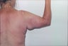 Arm lift