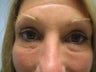Thermage Eye's
