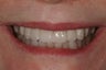 Full Mouth Reconstruction