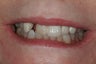 Full Mouth Reconstruction