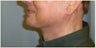 Chin Implants