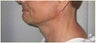 Chin Implants
