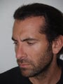 Hair Transplant and Rhinoplasty