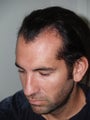 Hair Transplant and Rhinoplasty