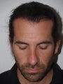 Hair Transplant and Rhinoplasty