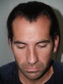 Hair Transplant and Rhinoplasty