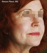 Sculptra for Facial Volume Restoration