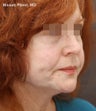 Sculptra for Facial Volume Restoration