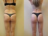 Liposculpture of buttocks