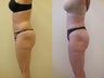 Liposculpture of buttocks