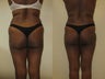 Brazilian butt lift