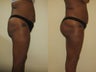 Brazilian butt lift
