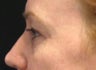 Fraxel CO2 Laser Resurfacing